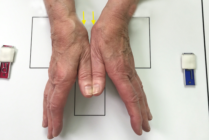 Osteoarthritis Carpometacarpal Cmc Joint Of Thumb Hand Surgery Resource 5097